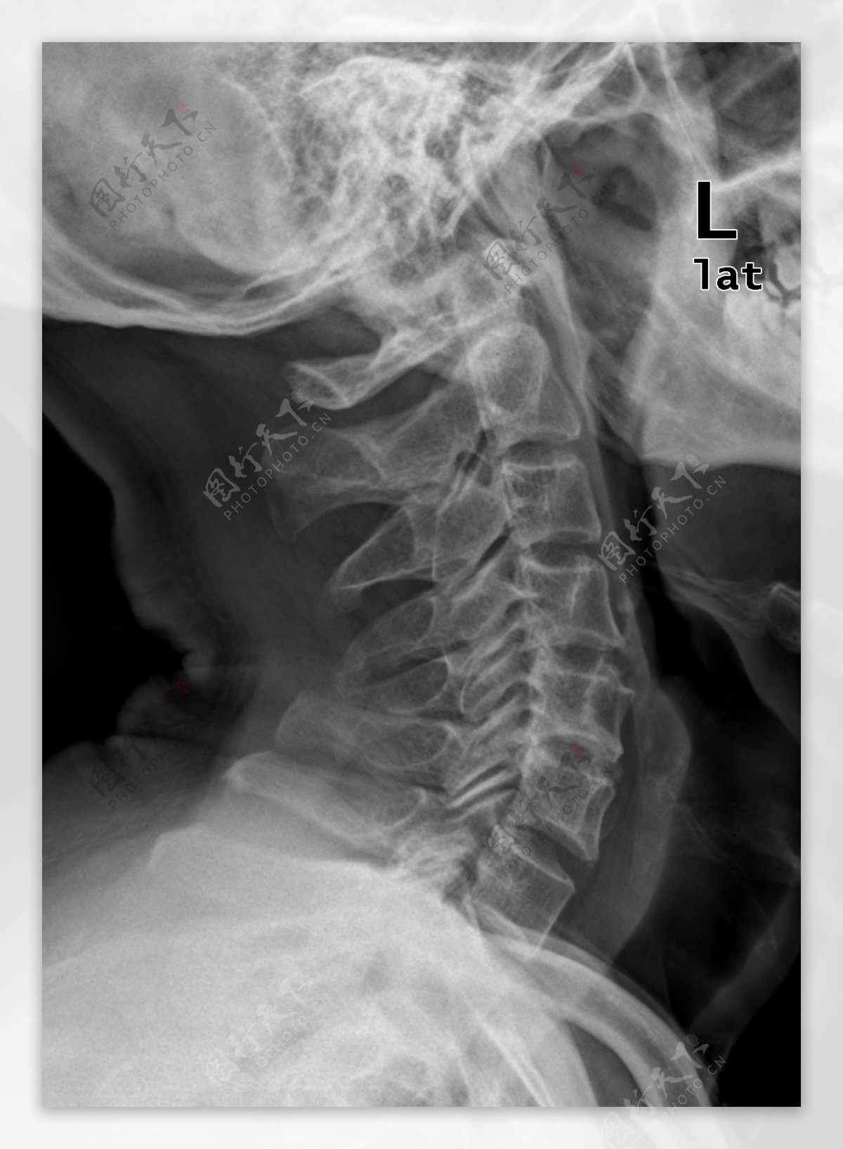 颈侧位骨科医生x光图片