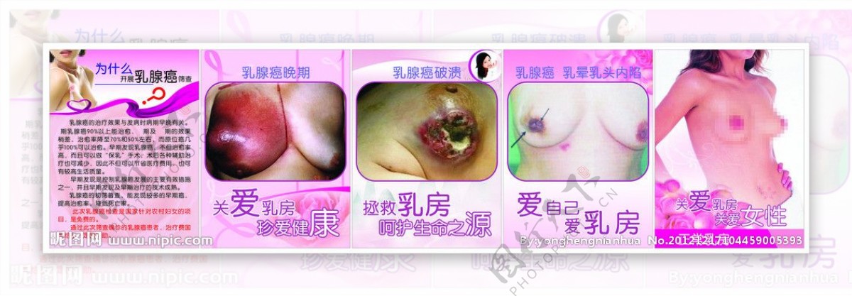 乳腺癌预防展板图片