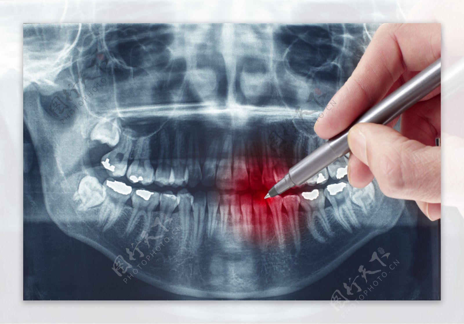 牙齿CT片图片